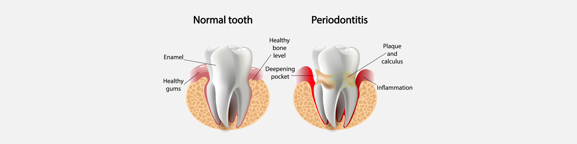 Periodontal Treatment
