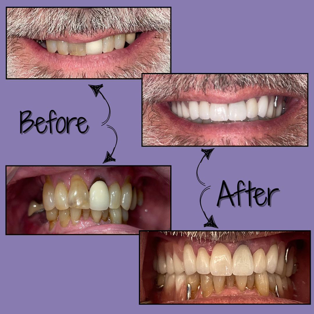 Dental Veneers in Phoenix