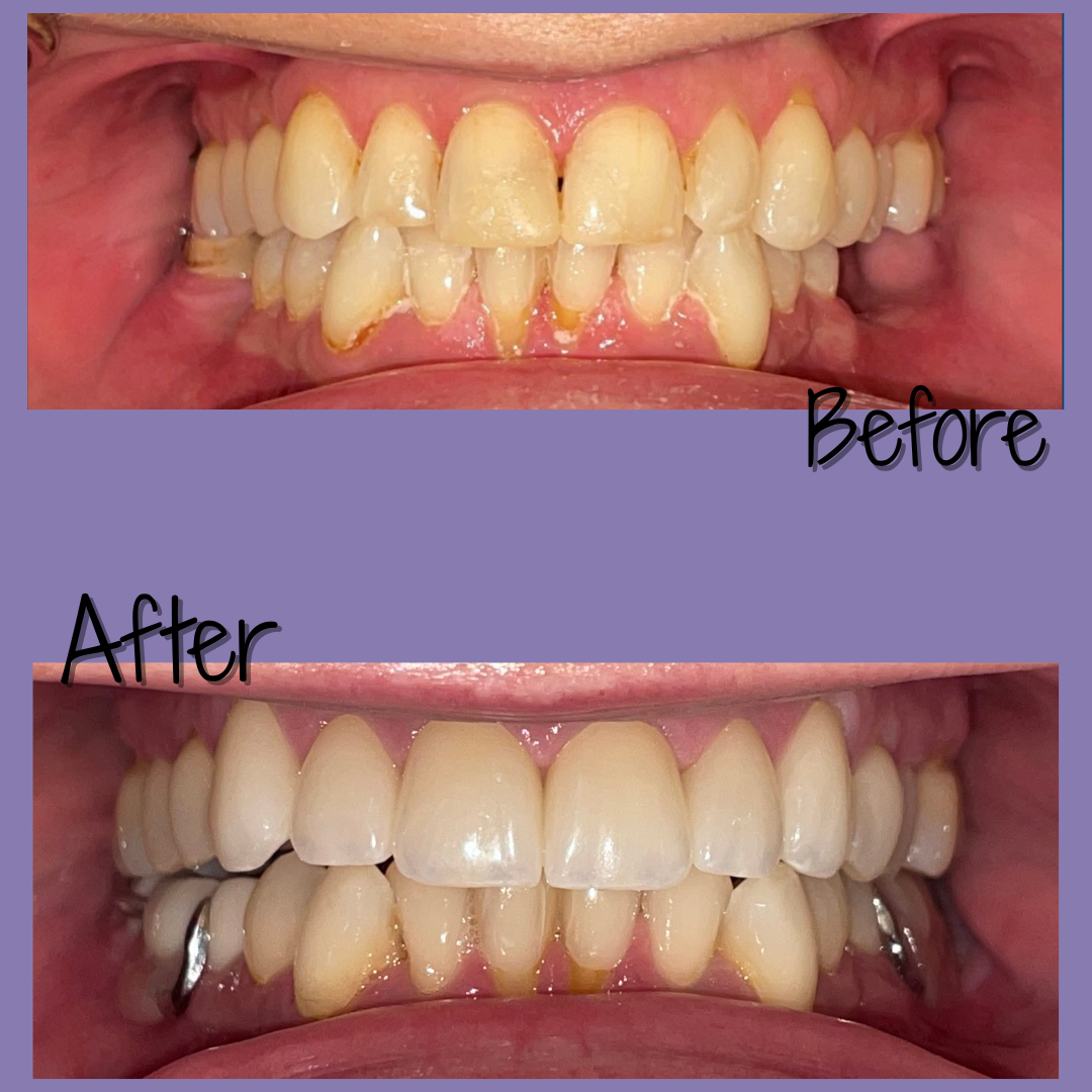 Dental bridges before after