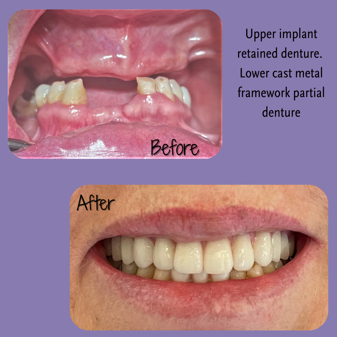 Dental implants before after