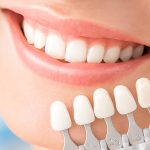 Veneers Unveiled: Deciding If They’re Right for Your Smile