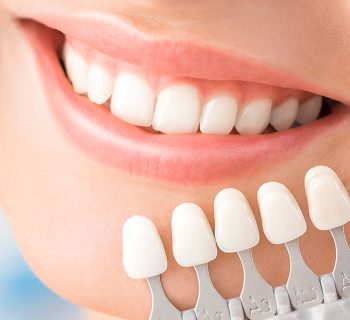 Veneers Unveiled: Deciding If They’re Right for Your Smile