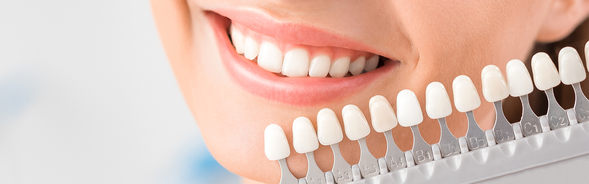 Veneers Unveiled: Deciding If They’re Right for Your Smile